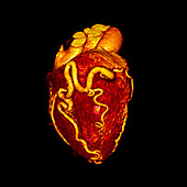 Enlarged coronary arteries