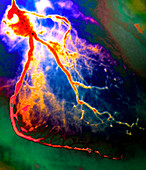 Narrowed coronary arteries,X-ray