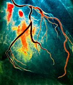 Narrowed coronary artery,X-ray