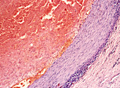 Coronary thrombosis,light micrograph