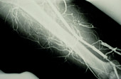 Venogram showing deep vein emboli