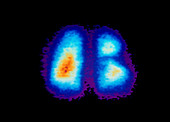 Colour gamma scan of lung with pulmonary embolism