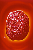 Illustration of blood cells & fibrin in a thrombus