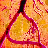 Coloured angiogram of iliac artery bypass