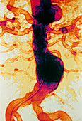Coloured arteriograph showing aortic aneurysm