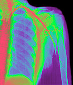 Coloured angiogram of embolus blocking arm artery