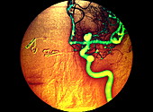 Aneurysm,X-ray