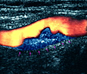 Atheroma plaque,Doppler ultrasound