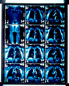 Deep vein thrombosis scans,MRIs