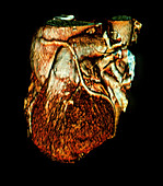 Heart after bypass,EBT scan