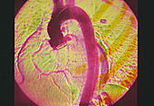 Artificial aorta,X-ray