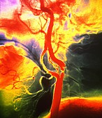 Artery stenosis,X-ray