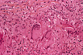 Inflamed artery tissue,light micrograph