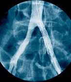 Stent in a narrowed artery,X-ray