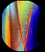 Femoral artery narrowing,X-ray