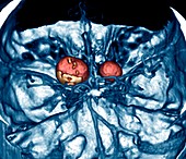 Brain aneurysms,3-D CT scan