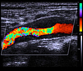 Atheroma plaque,doppler ultrasound