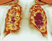 Loss of lung tissue,X-ray