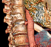 Aortic aneurysm,CT scan