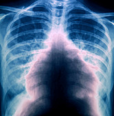 Pulmonary embolism,X-ray