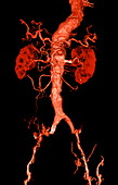 Arterial stents,CT scan
