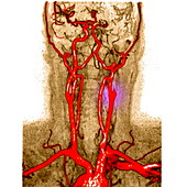 Blocked artery,angiogram