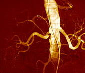 Narrowed renal artery,X-ray