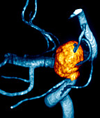 Carotid aneurysm,digital angiogram