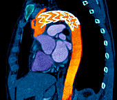 Stent in a dissecting aorta,CT scan
