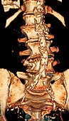 Atheroma plaques,CT scan