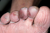 Ischaemic toes