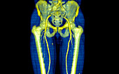 Iliac aneurysm,CT scan