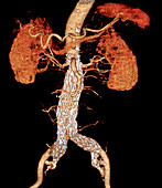 Stent in the abdominal aorta,3D CT scan