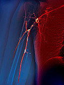Takayasu's arteritis,angiogram