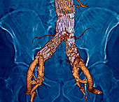 Stent in the abdominal aorta,3D CT scan