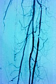Stenosis of leg vessels,angiogram