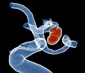 Carotid aneurysm,angiogram