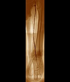 Arteritis of the leg,angiogram