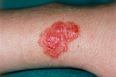 The arm of a patient affected by impetigo