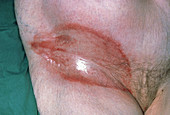 Intertrigo rash on elderly woman's groin