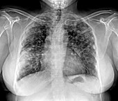 Lung disease,X-ray