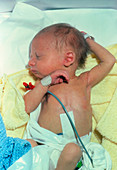 New-born infant suffering from jaundice