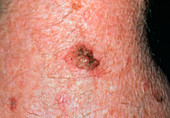 A solar keratosis found on an elderly person