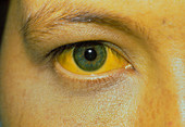 Jaundice: eye and skin of a patient