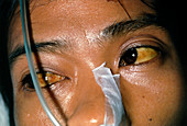 Malaria patient with jaundice,eyes and face