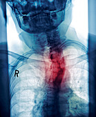 Curved spine,X-ray