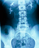 Intravenous pyelogram showing duplex kidney