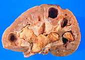Sectioned kidney showing large staghorn s