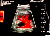 Doppler ultrasound of kidney with renal dystrophy