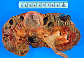 Gross specimen: polycystic disease of a kidney